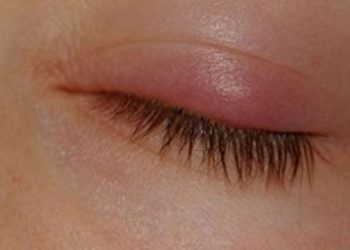 Comment guérir rapidement un chalazion ?