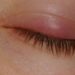 Comment guérir rapidement un chalazion ?