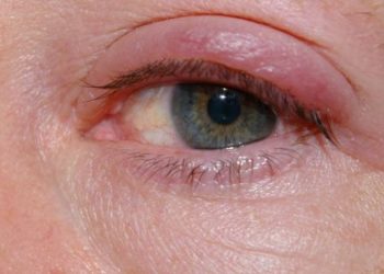 Comment se débarrasser d'un chalazion naturellement ?