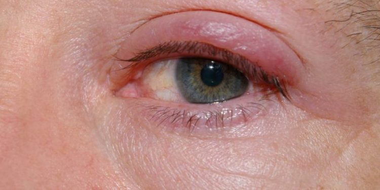 Comment se débarrasser d'un chalazion naturellement ?