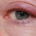 Comment se débarrasser d'un chalazion naturellement ?