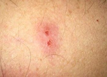 Quel insecte m'a piqué la nuit dans le lit ?