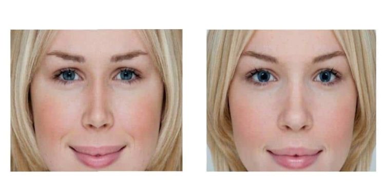 Comment faire pour ne plus avoir les pupilles Dilatee ?