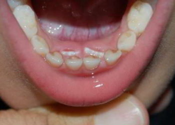 Pourquoi les dents sont de travers ?