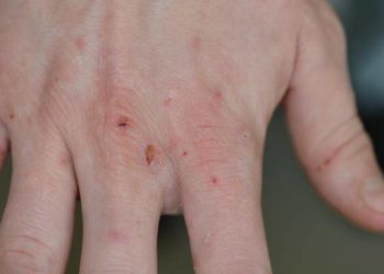 Comment un animal attrape la gale ?