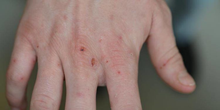 Comment un animal attrape la gale ?