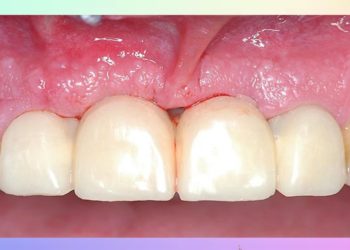 Comment soigner une inflammation de la gencive naturellement ?