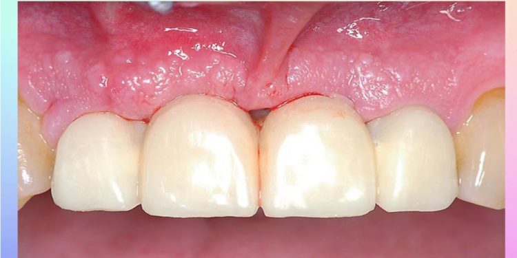 Comment soigner une inflammation de la gencive naturellement ?