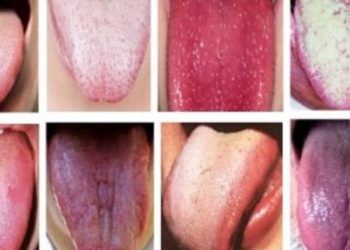 Quelle est la couleur d'une langue en bonne santé ?