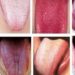 Quelle est la couleur d'une langue en bonne santé ?