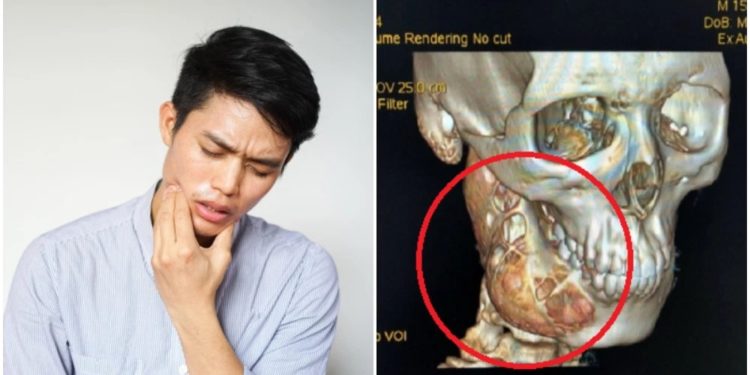 Comment débute un cancer de la mâchoire ?