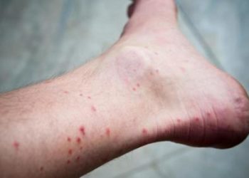 Comment savoir si on a été piqué par des punaises de lit ?