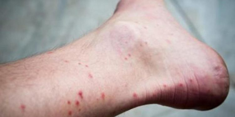 Comment savoir si on a été piqué par des punaises de lit ?