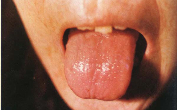 Pourquoi ma langue est marron ?