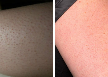 C'est quoi ces points rouges sur la peau ?