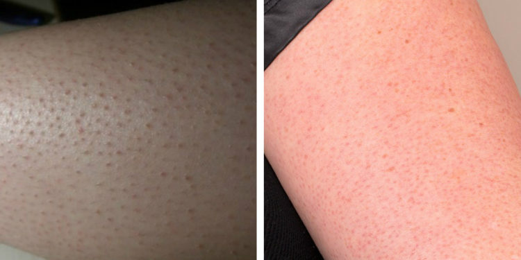 C'est quoi ces points rouges sur la peau ?