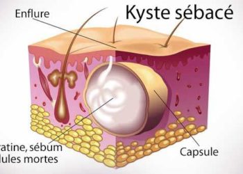 Comment soigner un kyste sébacé naturellement ?