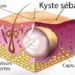 Comment soigner un kyste sébacé naturellement ?