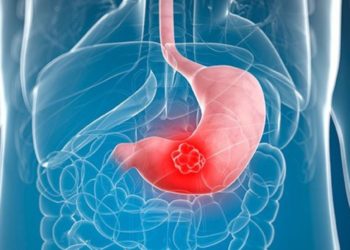 Quels sont les premiers symptômes du cancer de l'estomac ?