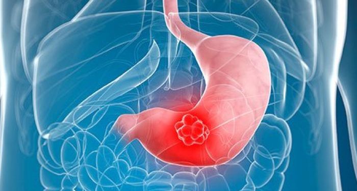 Quels sont les premiers symptômes du cancer de l'estomac ?