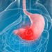 Quels sont les premiers symptômes du cancer de l'estomac ?