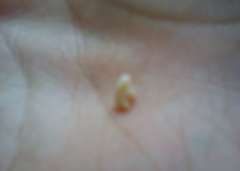 Quand je me racle la gorge je crache du sang ?