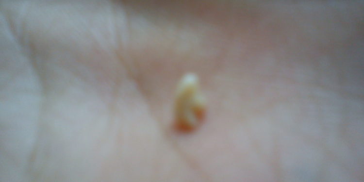 Quand je me racle la gorge je crache du sang ?