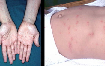 Comment savoir si l'on a la gale ?