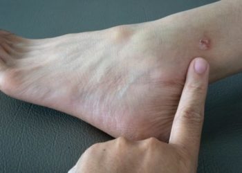 Comment Attrape-t-on la teigne chez l'homme ?