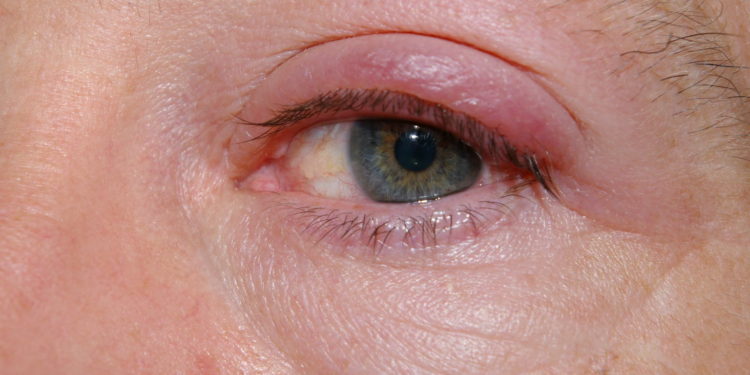 Est-ce qu'un orgelet part tout seul ?