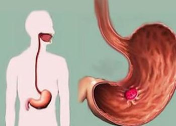 Comment guérir d'un ulcère à l'estomac ?