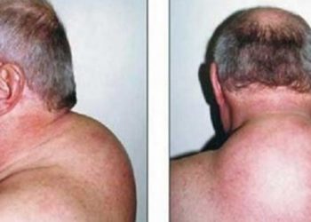 Comment se débarrasser de la bosse de bison ?