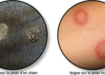 C'est quoi la tularémie ?