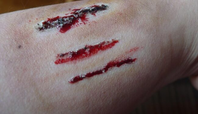 Comment Desinfecter une griffure ?