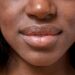 Comment aider la peau à cicatriser ?