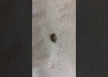 Comment enlever une tique sans corps ?