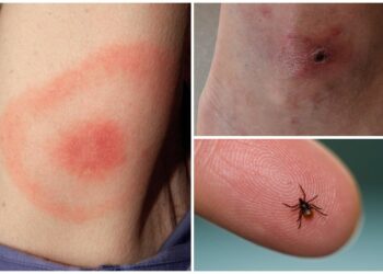 Comment savoir depuis combien de temps on a une tique ?