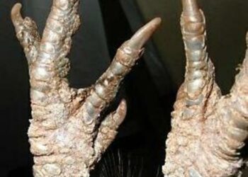 Comment se débarrasser de la gale remède de Grand-mère ?