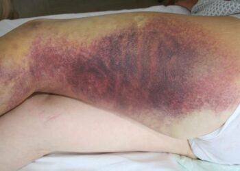 Comment soigner une morsure de vipère ?