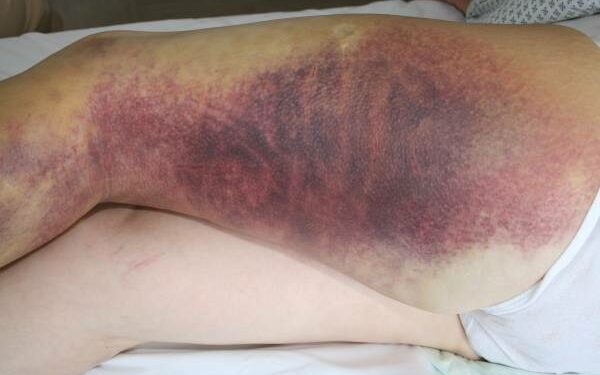 Comment soigner une morsure de vipère ?