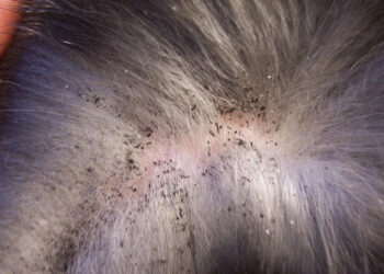 Est-ce que les lentes ça gratte ?