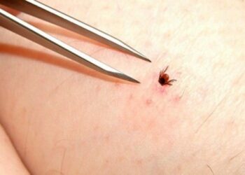 Quand s'inquiéter d'une piqûre de tique ?