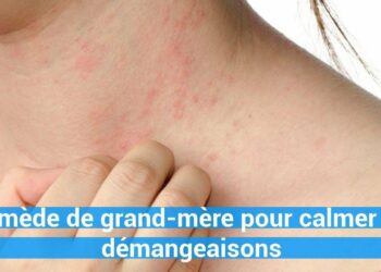 Quelle plante contre les démangeaisons ?