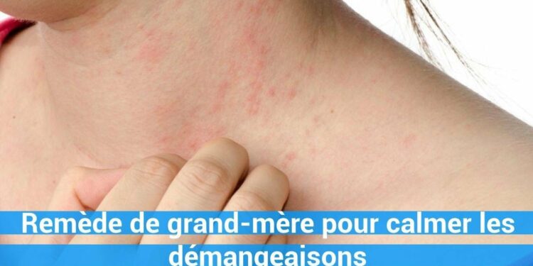 Quelle plante contre les démangeaisons ?